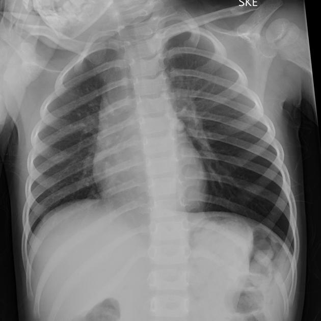 Foreign body inhalation_Table Image 3 Foreign body inhalation_Table Image 3